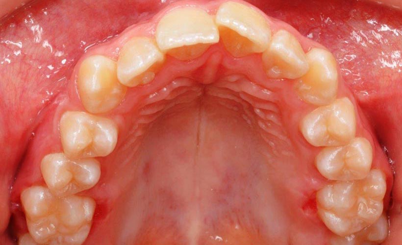 Vor Invisalign - Behandlung