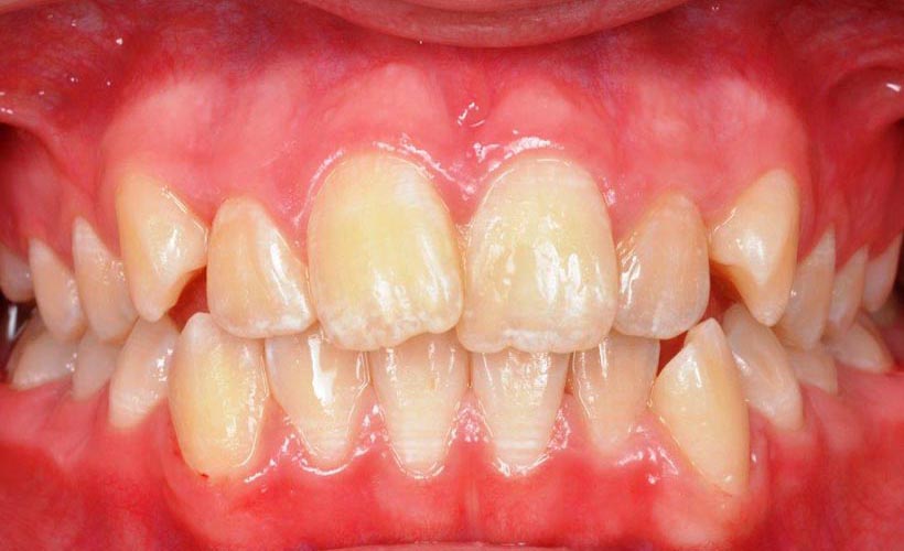 Vor Invisalign - Behandlung